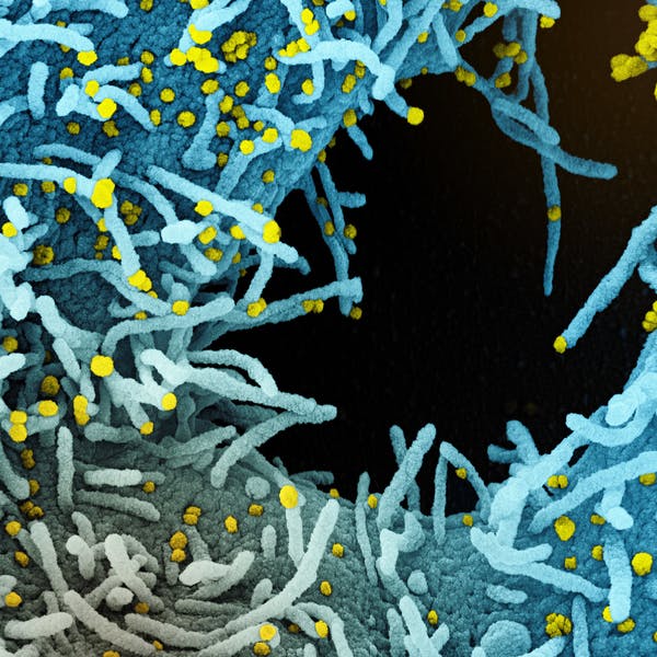Micrographie électronique à balayage d'une cellule fortement infectée par des particules du virus du SARS-CoV-2 (en jaune), isolée à partir d'un échantillon prélevé sur un patient. NIAID/NIH